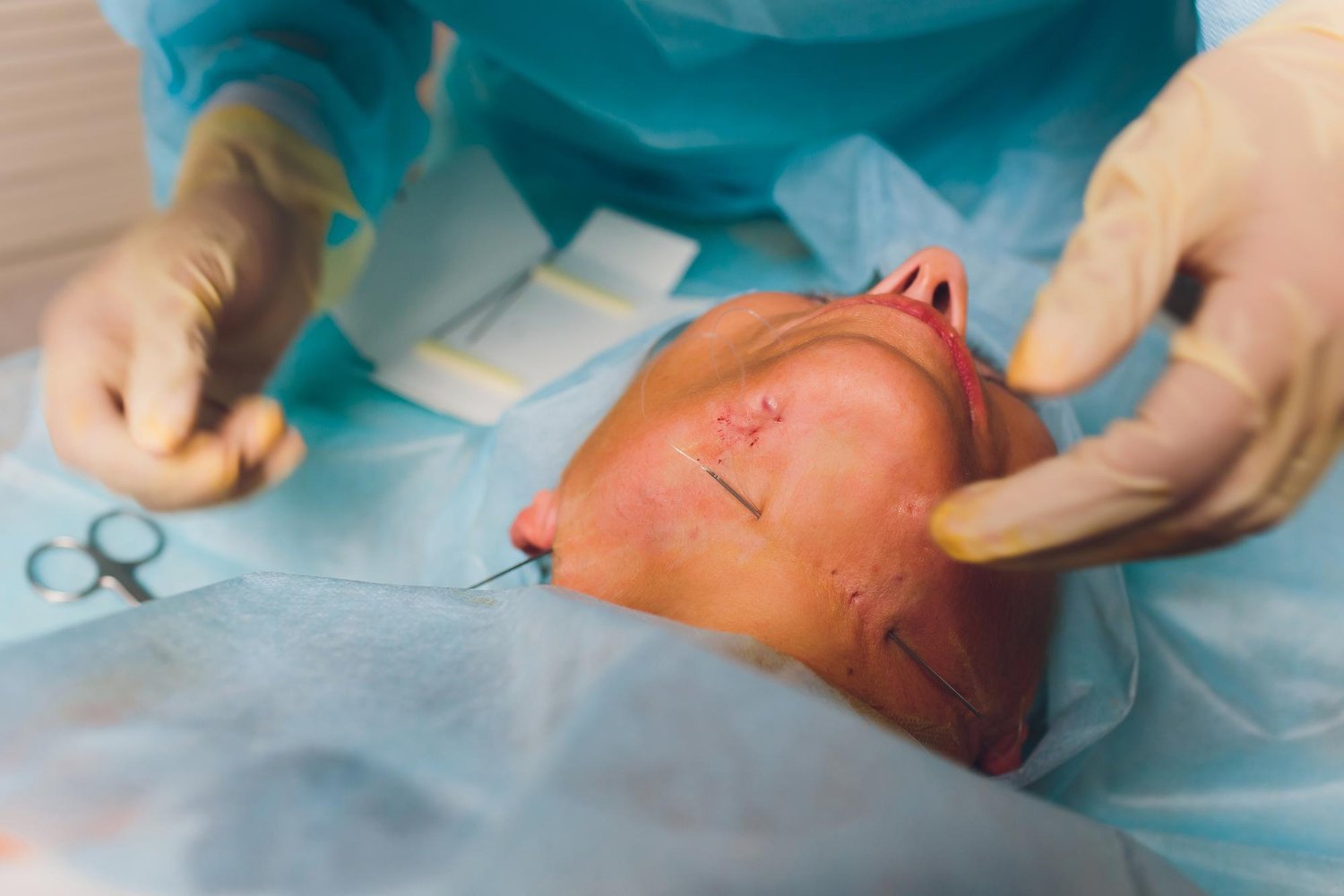  Ilizarov Surgery